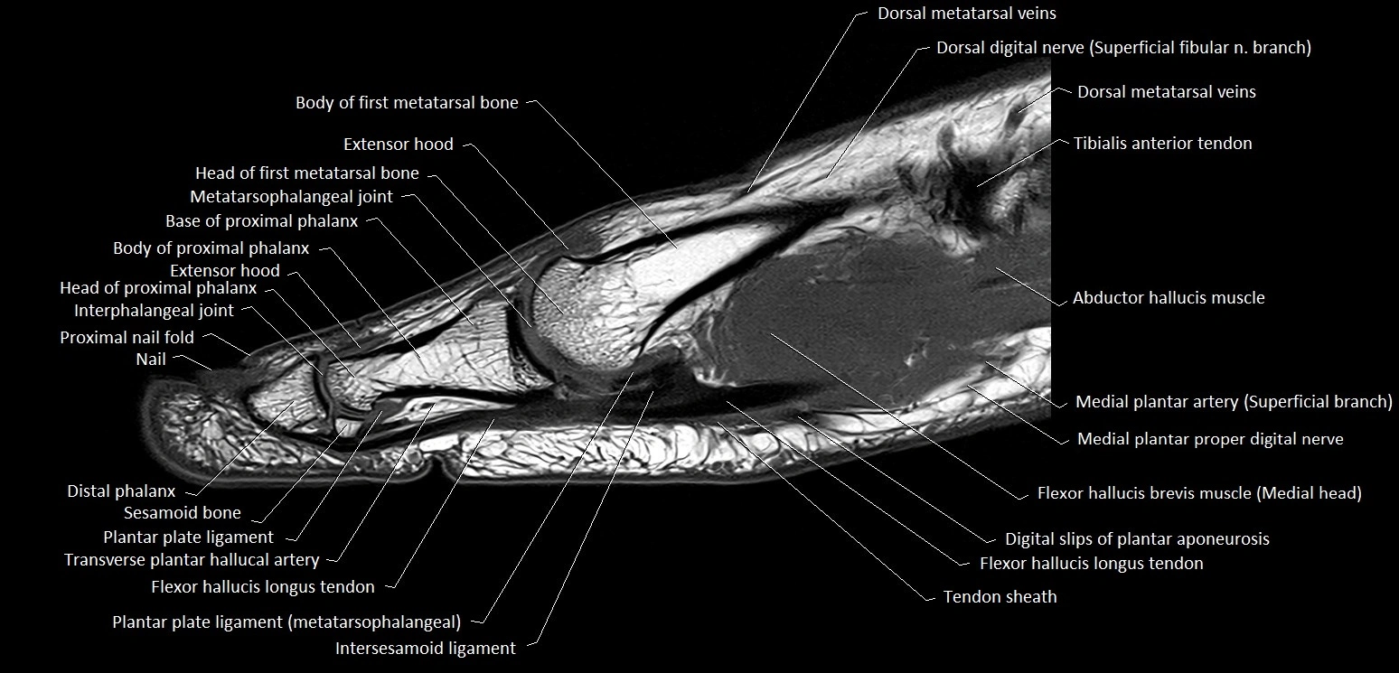 Hallux or big toe sagittal anatomy 3T MRI image 11.webp